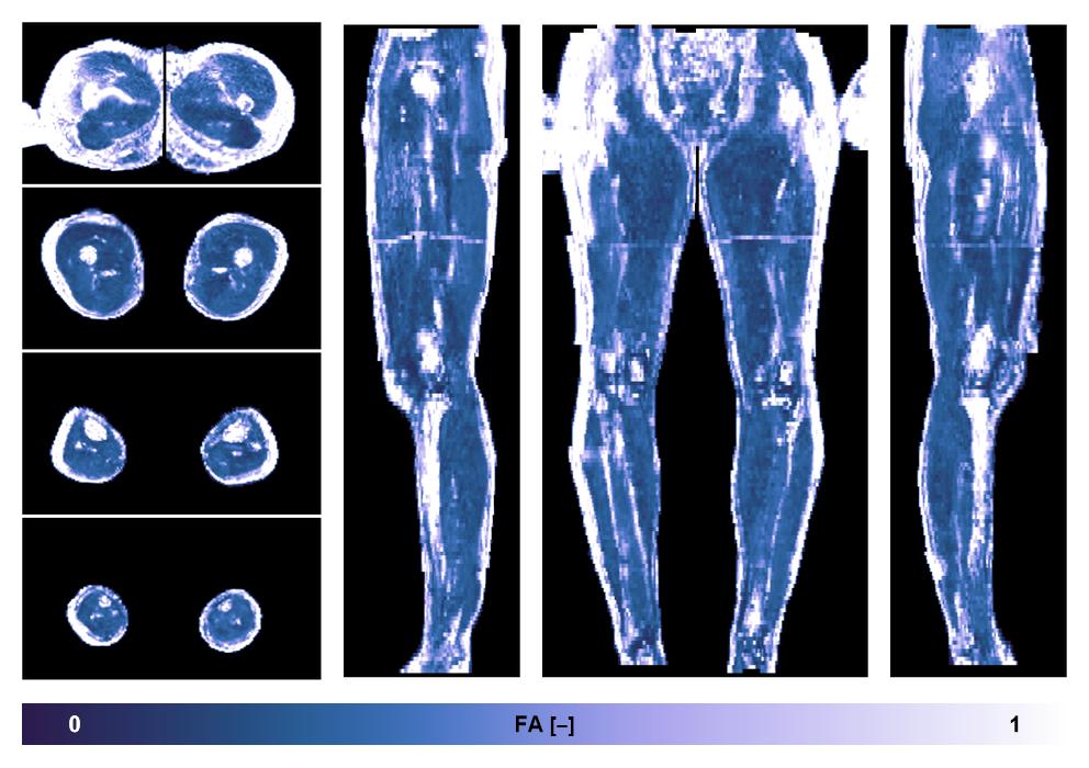 IVIM corrected whole leg muscle fractional anisotropy obtained from diffusion tensor imaging.